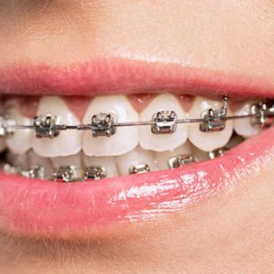 انواع تقويمات الاسنان
